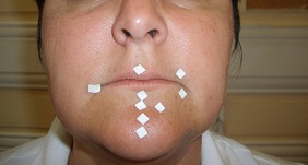 Application de patches sur les points réflexes du menton et des lèvres d'une patiente